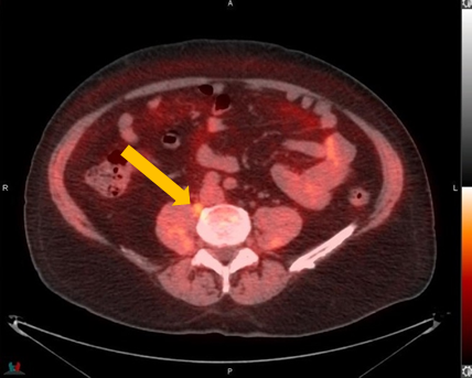 Positive Axumin PET/CT scan revealing paracaval lymph node malignant uptake