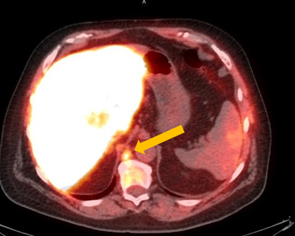 Positive Axumin PET/CT scan revealing retrocrural lymph node malignant uptake