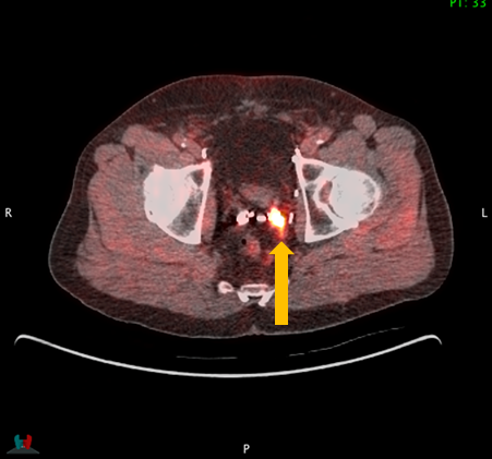 Axumin PET/CT scan revealing avid recurrent disease within the left seminal vesicle along the superior left pelvic side wall