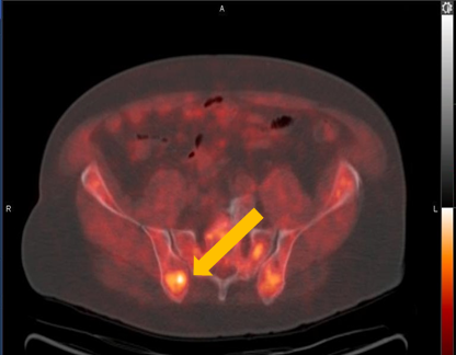 Positive Axumin PET/CT scan revealing right ilium skeletal uptake