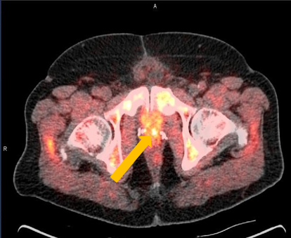 Positive Axumin PET/CT scan revealing left prostatectomy bed uptake
