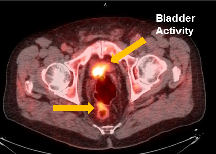 Positive Axumin PET/CT scan revealing interior perirectal malignant lymph node uptake and bladder activity