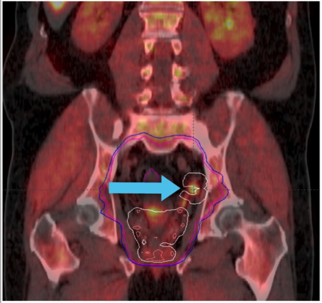 Positive Axumin PET/CT scan informs XRT volume planning