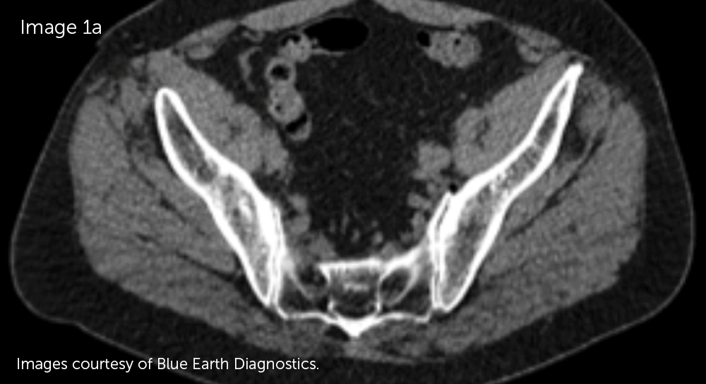 Axial view of inconclusive CT imaging of prostate following radical prostatectomy and negative lymphadenectomy