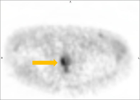 Positive Axumin black-and-white PET/CT scan revealing right mid-peripheral zone malignant uptake