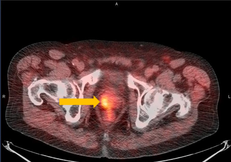 Axumin imaging revealed right mid peripheral zone malignant uptake