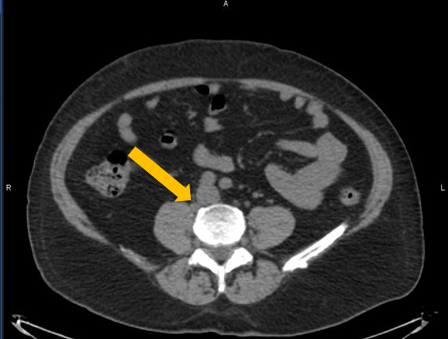 Positive Axumin black-and-white PET/CT scan revealing paracaval lymph node malignant uptake