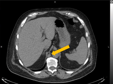 Positive Axumin black-and-white PET/CT scan revealing retrocrural lymph node malignant uptake