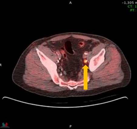 Positive Axumin PET/CT scan revealing avid 8-mm lymph node along superior left pelvic side wall, adjacent to surgical clip