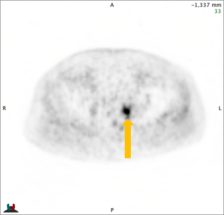 Positive Axumin black-and-white scan showing 8-mm lymph node along superior left pelvic side wall, adjacent to surgical clip