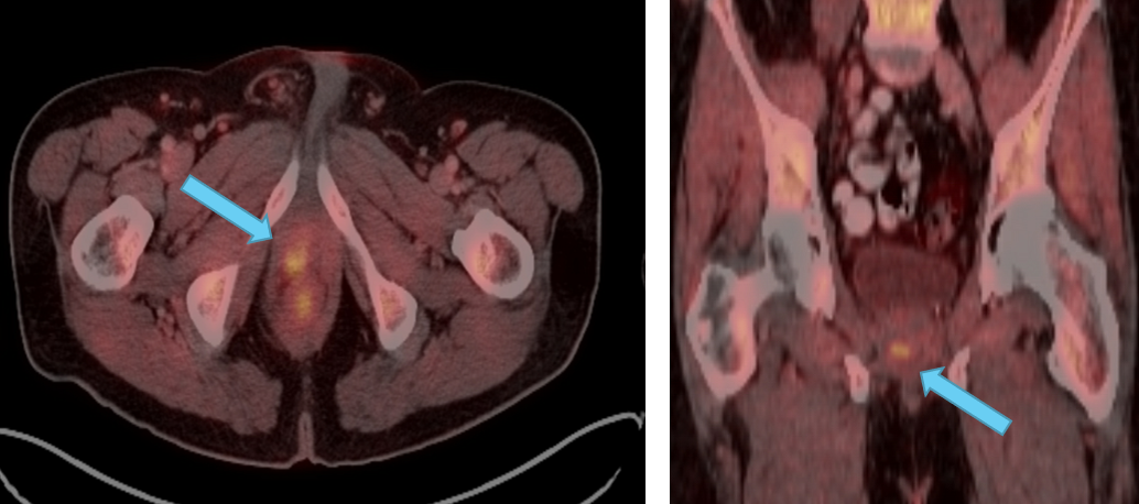 Positive Axumin PET/CT scans of prostate with focal uptake