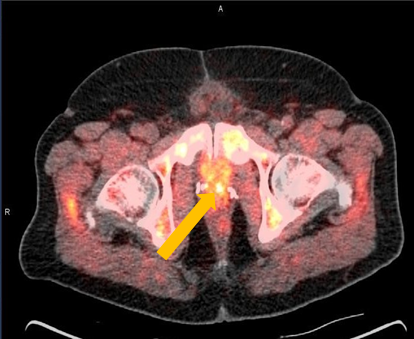 axumin pet scan side effects