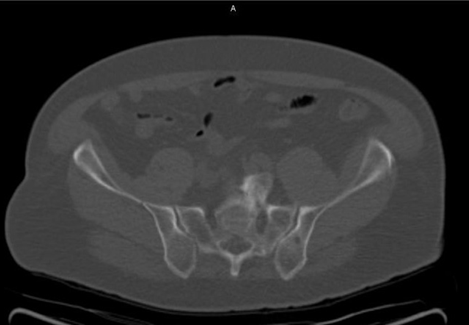 Positive Axumin black-and-white PET/CT scan revealing left prostatectomy bed uptake