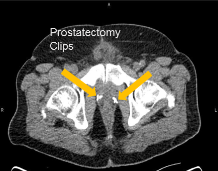 Positive Axumin black-and-white PET/CT scan revealing left prostatectomy bed uptake and prostatectomy clips