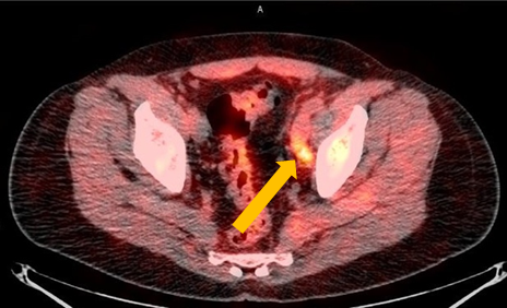 Positive Axumin PET/CT scan revealing a left obturator lymph node positive uptake