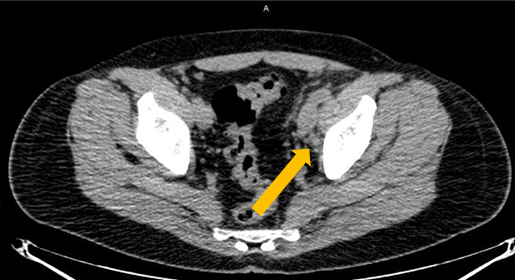 Positive Axumin black-and-white PET/CT scan revealing a left obturator lymph node positive uptake