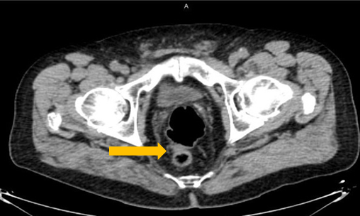 Positive Axumin black-and-white PET/CT scan revealing interior perirectal malignant lymph node uptake