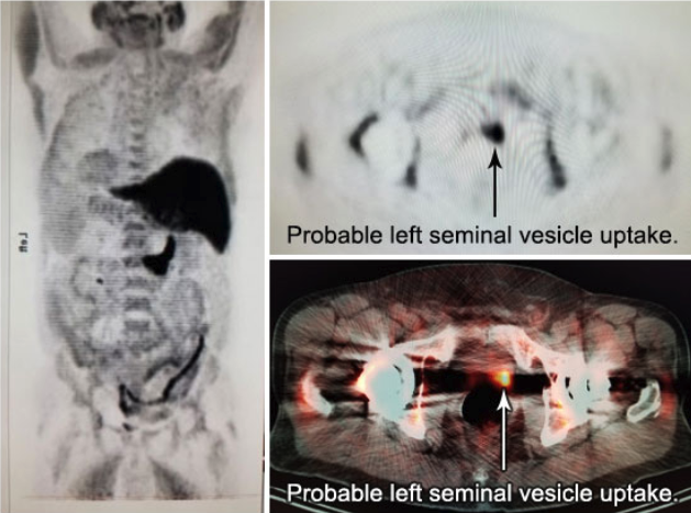 Probable left seminal vesicle uptake