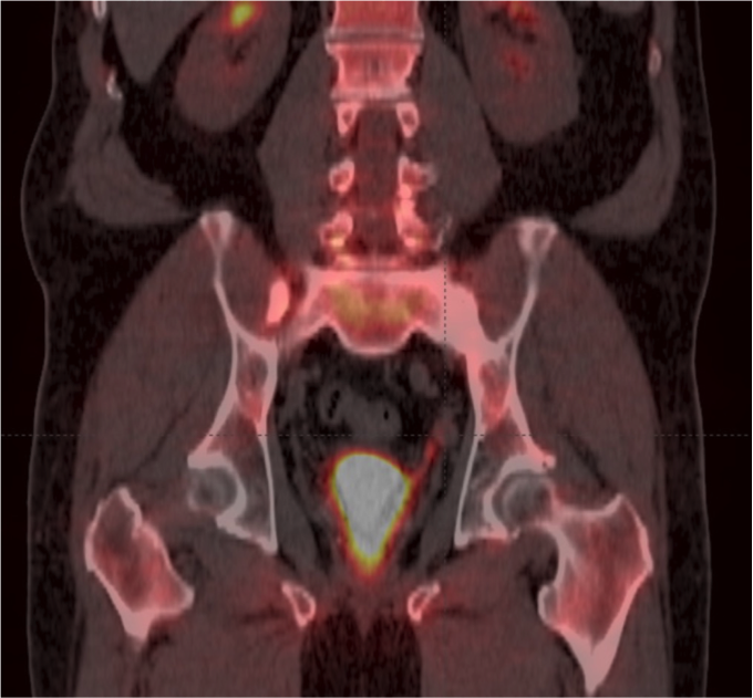 Sodium fluoride PET/CT bone scan of pelvic region