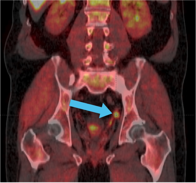 Positive Axumin PET/CT scan showing increased tracer uptake in the left pelvis and no evidence of distant disease