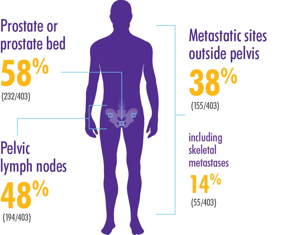 Graphic showing the distribution of recurrent and metastatic sites in men with positive Axumin scans
